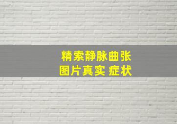 精索静脉曲张图片真实 症状